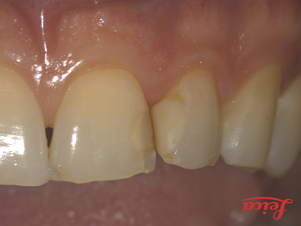 AESTHETIC PHOTOCOMPOSITE FILLINGS